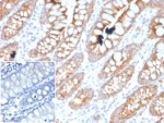 IHC staining of FFPE human colon tissue with PDGF beta antibody (clone PDGFB/3071). Negative control inset: PBS instead of primary antibody to control for secondary binding. HIER: boil tissue sections in pH 9 10mM Tris with 1mM EDTA for 20 min and allow to cool before testing.