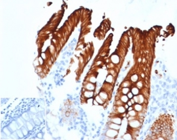 IHC staining of FFPE human colon carcinoma tissue with recombinant Keratin 20 antibody (clone KRT20/4879R) at 2ug/ml. Inset: PBS instead of primary Ab to control for secondary Ab binding. HIER: boil tissue sections in pH 9 10mM Tris with 1mM EDTA for 20 min and allow to cool before testing.