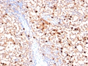 IHC staining of FFPE human bone marrow with MPO antibody (clone MPO/7116). HIER: boil tissue sections in pH 9 10mM Tris with 1mM EDTA for 20 min and allow to cool before testing.~