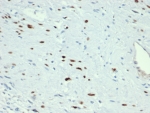 IHC staining of FFPE human rhabdomyosarcoma tissue with recombinant MyoD1 antibody (clone MYOD1/3418R) at 2ug/ml in PBS. HIER: boil tissue sections in pH 9 10mM Tris with 1mM EDTA for 20 min and allow to cool before testing.