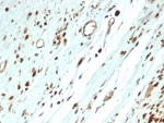 IHC staining of FFPE human rhabdomyosarcoma with recombinant MyoD1 antibody (clone MYOD1/3418R) at 2ug/ml. HIER: boil tissue sections in pH 9 10mM Tris with 1mM EDTA for 20 min and allow to cool before testing.