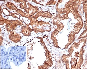 IHC staining of FFPE human prostate carcinoma tissue with recombinant Integrin Associated Protein antibody (clone rCD47/6365). Negative control inset: PBS instead of primary antibody to control for secondary binding. HIER: boil tissue sections in pH 9 10mM Tris with 1mM EDTA for 20 min and allow to cool befo