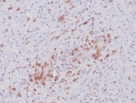 IHC staining of FFPE human anaplastic large cell lymphoma tissue with recombinant ALK antibody(clone ALK1/6698R) at 2ug/ml. HIER: boil tissue sections in pH 9 10mM Tris with 1mM EDTA for 20 min and allow to cool before testing.