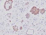 IHC staining of FFPE human lung adenocarcinoma tissue with recombinant ALK antibody (clone ALK1/6698R) at 2ug/ml in PBS. HIER: boil tissue sections in pH 9 10mM Tris with 1mM EDTA for 20 min and allow to cool before testing.
