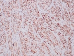 IHC staining of FFPE human inflammatory myofibroblastic tumor with recombinant ALK antibody (clone ALK1/6698R) at 2ug/ml. HIER: boil tissue sections in pH 9 10mM Tris with 1mM EDTA for 20 min and allow to cool before testing.