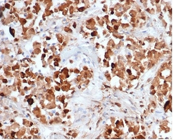 IHC staining of FFPE human pituitary tissue with recombinant GH1 antibody (clone rGH/4887). HIER: boil tissue sections in pH 9 10mM Tris with 1mM EDTA for 20 min and allow to cool before testing.~