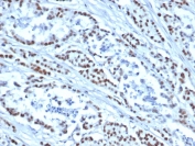 IHC staining of FFPE human colon tissue with recombinant MSH6 antibody (clone MSH6/4592R). HIER: boil tissue sections in pH 9 10mM Tris with 1mM EDTA for 20 min and allow to cool before testing.
