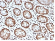 IHC staining of FFPE human colon tissue with recombinant MSH6 antibody (clone MSH6/4592R). HIER: boil tissue sections in pH 9 10mM Tris with 1mM EDTA for 20 min and allow to cool before testing.