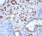 IHC staining of FFPE human prostate carcinoma tissue with recombinant AR antibody (clone rDHTR/6818). Negative control inset: PBS instead of primary antibody to control for secondary binding. HIER: boil tissue sections in pH 9 10mM Tris with 1mM EDTA for 20 min and allow to cool before testing.