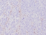 IHC staining of FFPE human Hereditary Nonpolyposis Colorectal Cancer (HNPCC) with recombinant MLH1 antibody (MLH1/6284R) at 2ug/ml.