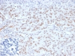 IHC staining of FFPE Lynch Syndrome / Hereditary Non-Polyposis Colorectal Cancer (HNPCC) with recombinant MLH1 antibody (clone MLH1/6284R) at 2ug/ml in PBS, 30 min RT. Negative control inset: PBS instead of primary antibody to control for secondary binding. HIER: boil tissue sections in pH 9 10mM Tris with 1mM EDTA for 20 min and allow to cool before testing.