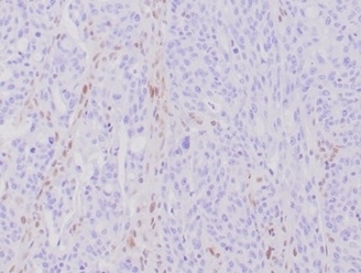IHC staining of FFPE human Hereditary Nonpolyposis Colorectal Cancer (HNPCC) with recombinant MLH1 antibody (MLH1/6284R) at 2ug/ml.