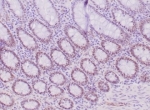 IHC staining of FFPE human colon carcinoma tissue with recombinant MLH1 antibody (clone MLH1/6284R). HIER: boil tissue sections in pH 9 10mM Tris with 1mM EDTA for 20 min and allow to cool before testing.