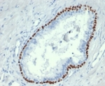 IHC staining of FFPE human prostate cancer tissue with recombinant p63 antibody (clone TP63/4379R). HIER: boil tissue sections in pH 9 10mM Tris with 1mM EDTA for 20 min and allow to cool before testing.