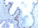 IHC staining of FFPE human prostate cancer tissue with recombinant p63 antibody (clone TP63/4379R). Negative control inset: PBS instead of primary antibody to control for secondary binding. HIER: boil tissue sections in pH 9 10mM Tris with 1mM EDTA for 20 min and allow to cool before testing.