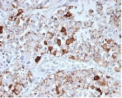 IHC staining of FFPE human pituitary tissue with Prolactin antibody (clone rPRL/4907). HIER: boil tissue sections in pH 9 10mM Tris with 1mM EDTA for 20 min and allow to cool before testing.