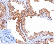 IHC staining of FFPE human prostate carcinoma tissue with recombinant CD47 antibody (clone rCD47/6589). Negative control inset: PBS instead of primary antibody to control for secondary binding. HIER: boil tissue sections in pH 9 10mM Tris with 1mM EDTA for 20 min and allow to cool before testing.