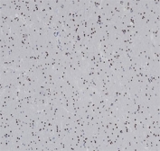 IHC staining of FFPE human glioma tissue with recombinant OLIG2 antibody (clone OLIG2/6695R). HIER: boil tissue sections in pH 9 10mM Tris with 1mM EDTA for 20 min and allow to cool before testing.