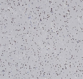 IHC staining of FFPE human glioma tissue with recombinant OLIG2 antibody (clone OLIG2/6695R). HIER: boil tissue sections in pH 9 10mM Tris with 1mM EDTA for 20 min and allow to cool before testing.
