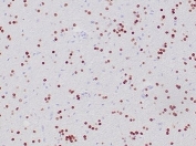 IHC staining of FFPE human oligodendroglioma tissue with recombinant OLIG2 antibody (clone OLIG2/6695R). HIER: boil tissue sections in pH 9 10mM Tris with 1mM EDTA for 20 min and allow to cool before testing.