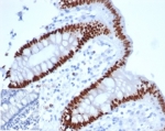 IHC staining of FFPE human colon adenocarcinoma tissue with recombinant Caudal Type Homeobox 2 antibody (clone rCDX2/6921) at 2ug/ml in PBS for 30min RT. Negative control inset: PBS instead of primary antibody to control for secondary binding. HIER: boil tissue sections in pH 9 10mM Tris with 1mM EDTA for 20 min and allow to cool before testing.