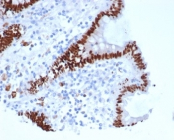 IHC staining of FFPE human colon carcinoma tissue with recombinant Caudal Type Homeobox 2 antibody (clone rCDX2/6921). HIER: boil tissue sections in pH 9 10mM Tris with 1mM EDTA for 20 min and allow to cool before testing.~
