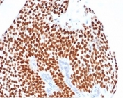 IHC staining of FFPE human bladder carcinoma tissue with recombinant GATA-3 antibody (clone GATA3/4550R). HIER: boil tissue sections in pH 9 10mM Tris with 1mM EDTA for 20 min and allow to cool before testing.