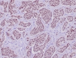 IHC staining of FFPE human neuroendocrine tumor tissue with recombinant INSM1 antibody (clone INSM1/6286R). HIER: boil tissue sections in pH 9 10mM Tris with 1mM EDTA for 20 min and allow to cool before testing.