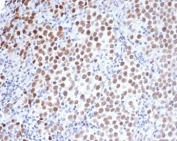IHC staining of FFPE human seminoma with Oct4 antibody (clone Oct4/3508). HIER: boil tissue sections in pH 9 10mM Tris with 1mM EDTA for 20 min and allow to cool before testing.