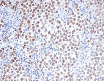 IHC staining of FFPE human seminoma with Oct4 antibody (clone Oct4/3508). HIER: boil tissue sections in pH 9 10mM Tris with 1mM EDTA for 20 min and allow to cool before testing.~