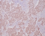 IHC staining of FFPE human seminoma tissue with recombinant Oct4 antibody (clone OCT4/6875R). HIER: boil tissue sections in pH 9 10mM Tris with 1mM EDTA for 20 min and allow to cool before testing.