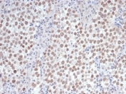 IHC staining of FFPE human seminoma tissue with recombinant Oct4 antibody (clone OCT4/6875R). HIER: boil tissue sections in pH 9 10mM Tris with 1mM EDTA for 20 min and allow to cool before testing.
