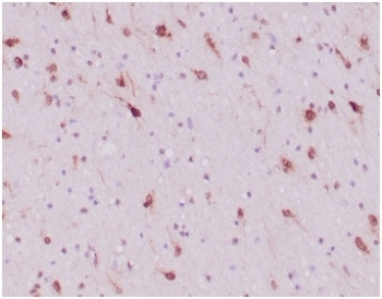 IHC staining of FFPE human glioblastoma tissue with IDH1-R132H antibody (clone IDH1/6806R). HIER: boil tissue sections in pH 9 10mM Tris with 1mM EDTA for 20 min and allow to cool before testing.