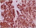 IHC staining of IDH1-R132H mutation protein in FFPE human prostate carcinoma tissue with IDH1-R132H antibody (clone IDH1/6806R). HIER: boil tissue sections in pH 9 10mM Tris with 1mM EDTA for 20 min and allow to cool before testing.