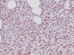 IHC staining of FFPE human breast carcinoma tissue with recombinant Estrogen Receptor alpha antibody (clone ESR1/6811R). HIER: boil tissue sections in pH 9 10mM Tris with 1mM EDTA for 20 min and allow to cool before testing.
