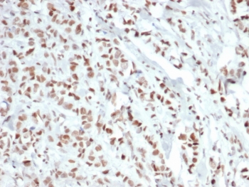 IHC staining of FFPE human breast carcinoma tissue with recombinant Estrogen Receptor alpha antibody (clone ESR1/6811R). HIER: boil tissue sections in pH 9 10mM Tris with 1mM EDTA for 20 min and allow to cool before testing.~