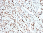 IHC staining of FFPE human breast carcinoma tissue with recombinant Estrogen Receptor alpha antibody (clone ESR1/6811R). HIER: boil tissue sections in pH 9 10mM Tris with 1mM EDTA for 20 min and allow to cool before testing.