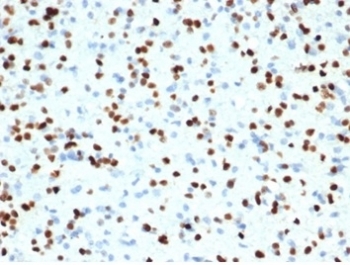 IHC staining of FFPE human brain tissue with recombinant OLIG2 antibody (clone OLIG2/7074R). HIER: boil tissue sections in pH 9 10mM Tris with 1mM EDTA for 20 min and allow to cool before testing.~