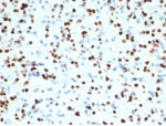 IHC staining of FFPE human brain tissue with recombinant OLIG2 antibody (clone OLIG2/7074R). HIER: boil tissue sections in pH 9 10mM Tris with 1mM EDTA for 20 min and allow to cool before testing.