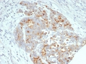 IHC staining of FFPE human ovarian carcinoma tissue with recombinant CFTR antibody (clone CFTR/7003R). HIER: boil tissue sections in pH 9 10mM Tris with 1mM EDTA for 20 min and allow to cool before testing.