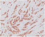 IHC staining of FFPE human breast carcinoma tissue with recombinant ERa antibody (clone ESR1/4039R). HIER: boil tissue sections in pH 9 10mM Tris with 1mM EDTA for 20 min and allow to cool before testing.
