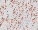 IHC staining of FFPE human breast carcinoma tissue with recombinant ERa antibody (clone ESR1/4039R). HIER: boil tissue sections in pH 9 10mM Tris with 1mM EDTA for 20 min and allow to cool before testing.