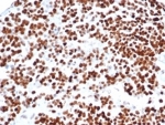 IHC staining of FFPE human serous ovarian carcinoma tissue with recombinant TP53 antibody (clone rTP53/6927). HIER: boil tissue sections in pH 9 10mM Tris with 1mM EDTA for 20 min and allow to cool before testing.