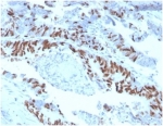 IHC staining of FFPE human colon carcinoma tissue with MCM2 antibody (clone MCM2/3678). HIER: boil tissue sections in pH 9 10mM Tris with 1mM EDTA for 20 min and allow to cool before testing.