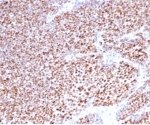 IHC staining of FFPE human breast carcinoma tissue with PGR antibody (clone PGR/3817). HIER: boil tissue sections in pH 9 10mM Tris with 1mM EDTA for 20 min and allow to cool before testing.
