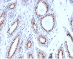 IHC staining of FFPE human breast carcinoma tissue with PGR antibody (clone PGR/3817). HIER: boil tissue sections in pH 9 10mM Tris with 1mM EDTA for 20 min and allow to cool before testing.