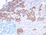 IHC staining of FFPE human serous ovarian carcinoma tissue with recombinant TP53 antibody (clone rTP53/6940). Negative control inset: PBS instead of primary antibody to control for secondary binding. HIER: boil tissue sections in pH 9 10mM Tris with 1mM EDTA for 20 min and allow to cool before testing.