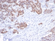 IHC staining of FFPE human serous ovarian carcinoma tissue with recombinant TP53 antibody (clone rTP53/6940). HIER: boil tissue sections in pH 9 10mM Tris with 1mM EDTA for 20 min and allow to cool before testing.