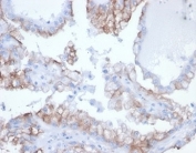 IHC staining of FFPE human kidney cancer tissue with recombinant Cdc20 antibody (clone rCDC20/7184) at 2ug/ml. HIER: boil tissue sections in pH 9 10mM Tris with 1mM EDTA for 20 min and allow to cool before testing.