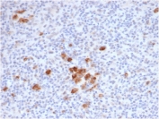 IHC staining of FFPE human Hodgkins lymphoma tissue with recombinant CD30 antibody (clone rKi-1/6913) at 2ug/ml in PBS for 30min RT. Staining of Reed-Sternberg cells is observed. HIER: boil tissue sections in pH 9 10mM Tris with 1mM EDTA for 20 min and allow to cool before testing.